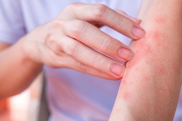 Close up of woman arm scratch the itch by hand at home itching due to rash fungus allergy dermatological disease dry skin Healthcare and medical concept