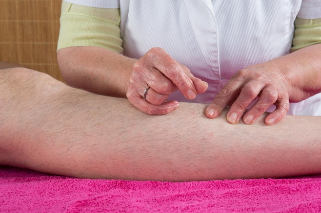 Close up of woman's hands doing acupuncture