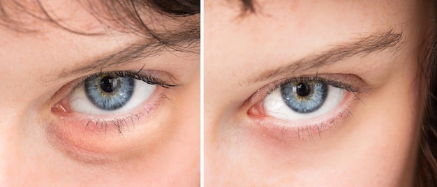 Close up of woman swollen eye before and after beauty treatment