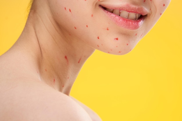 Close-up of woman with chickenpox against yellow background