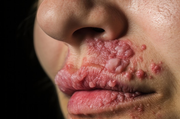 Photo a close up of a woman with a lot of pimples on her face