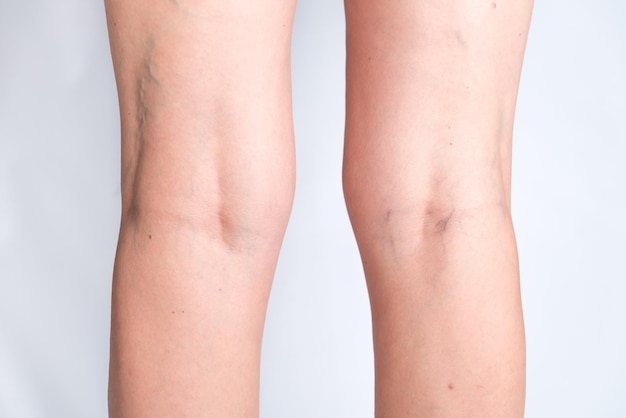 close up womans legs with genu valgus and many varicose veins bad posture