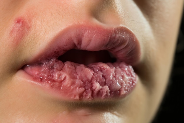 Foto un primo piano della bocca di una donna con una grande quantità di pelle sulle labbra