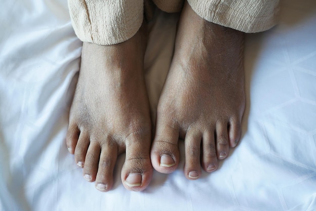 Photo close up of women feet with swelling