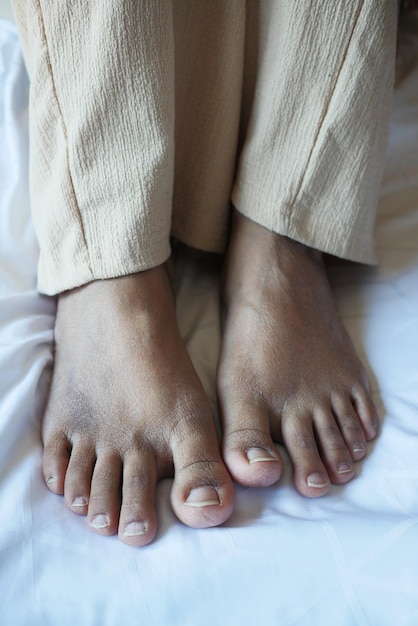 Close up of women feet with swelling