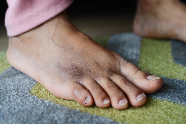 Photo close up of women feet with swelling