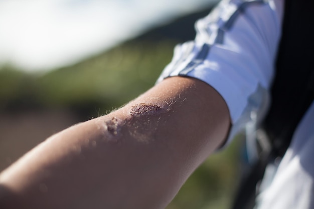 Photo close-up of wounded hand of man