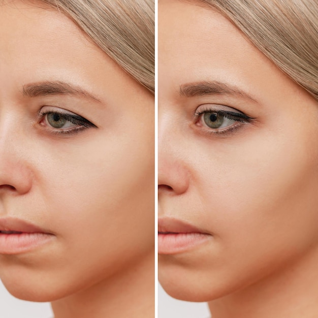 Close up of a young blonde woman\'s face with drooping upper\
eyelid before and after blepharoplasty