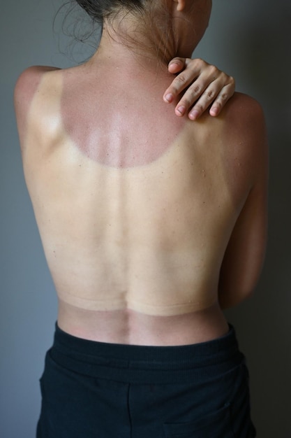 Close up of young naked woman with sunburn marks on the body, studio gray background