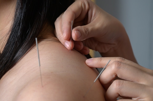 close up young woman getting acupuncture treatment