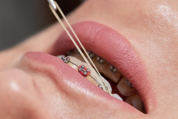 Close-upbeugels op tanden met elastieken orthodontische behandeling vooraanzicht tandbeugels