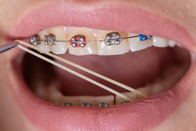 Close-upbeugels op tanden met elastieken orthodontische behandeling vooraanzicht tandbeugels