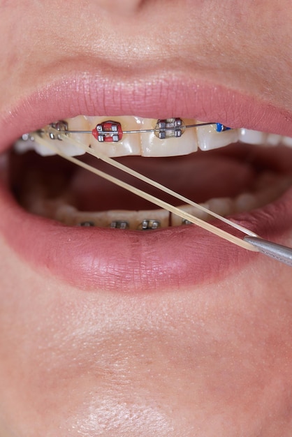 Close-upbeugels op tanden met elastieken orthodontische behandeling vooraanzicht tandbeugels