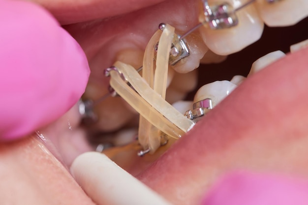 Close-upbeugels op tanden met elastieken orthodontische behandeling vooraanzicht tandbeugels