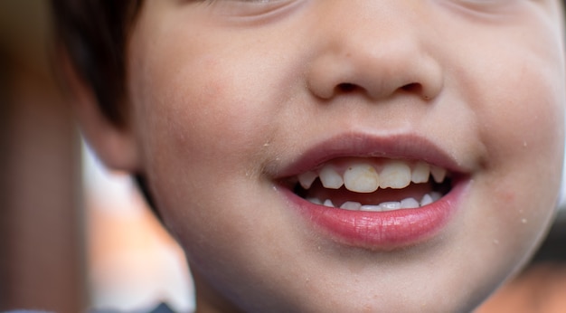 사진 미소로 어린 소년 입의 닫힌된 사진입니다. 노란색으로 치아를 볼 수 있습니다.