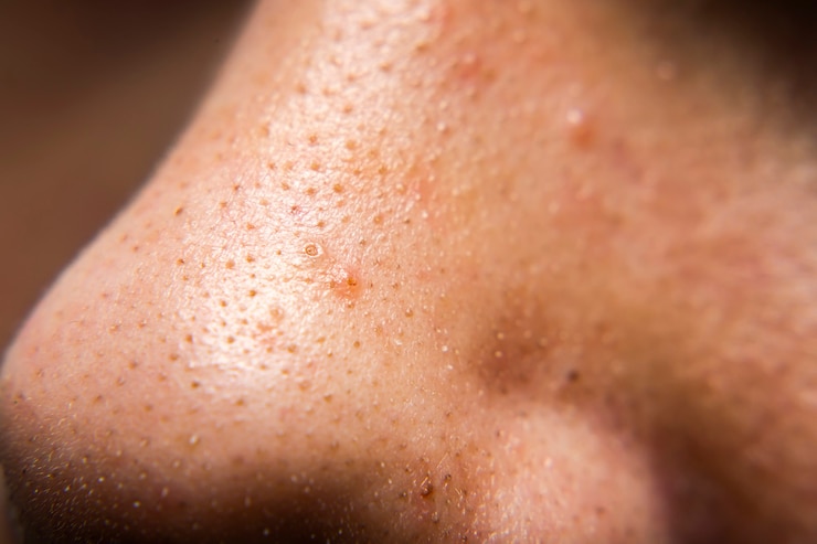 Photo closed-up of pimple blackheads on the nose of an european teenager, enlarged pores on the face
