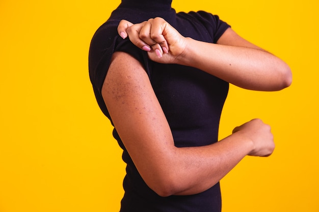 Photo closeup on arm of afro woman with allergy.