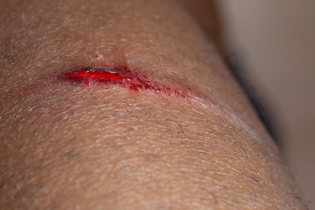 Closeup of bleeding gash on human arm requiring first aid care