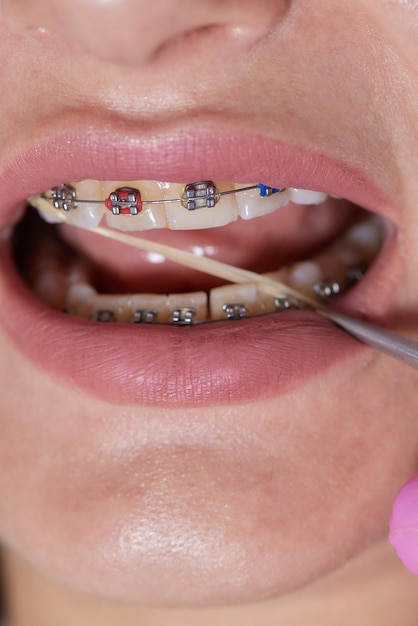 Брекеты крупным планом на зубах с ортодонтическим лечением эластиками вид спереди зубные брекеты