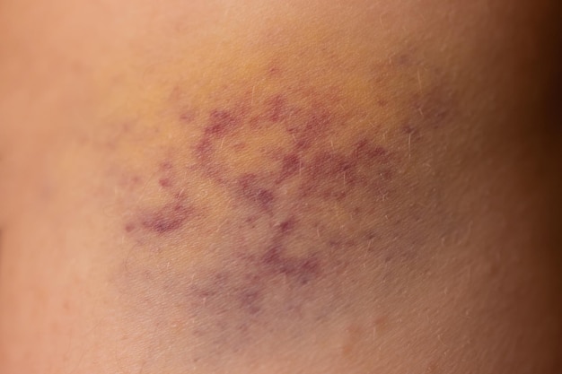 Photo closeup bruise on wounded woman's leg skin.