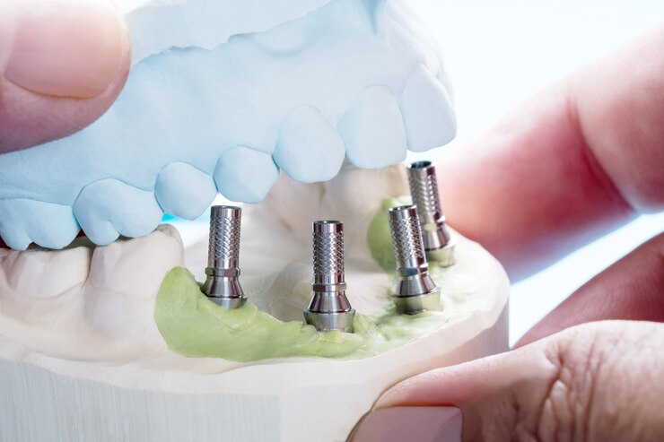 Closeup/ Convertible abutment components/ Dental implant temporary abutment/ Abutment screw implant.