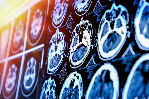 뇌 의학 과학 및 교육 MRI 뇌 배경으로 CT 스캔 확대