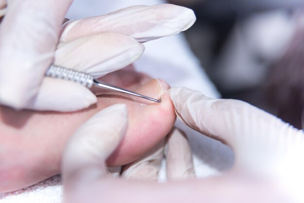 Closeup of Cuticle Removal during Mens Pedicure at Spa