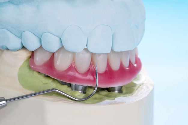 Closeup/ Dental implants supported overdenture on blue background/ Screw retained/ implant restorations.