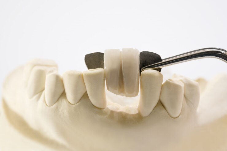 Closeup / Dental maryland bridge / Crown and bridge equipment and model express fix restoration.