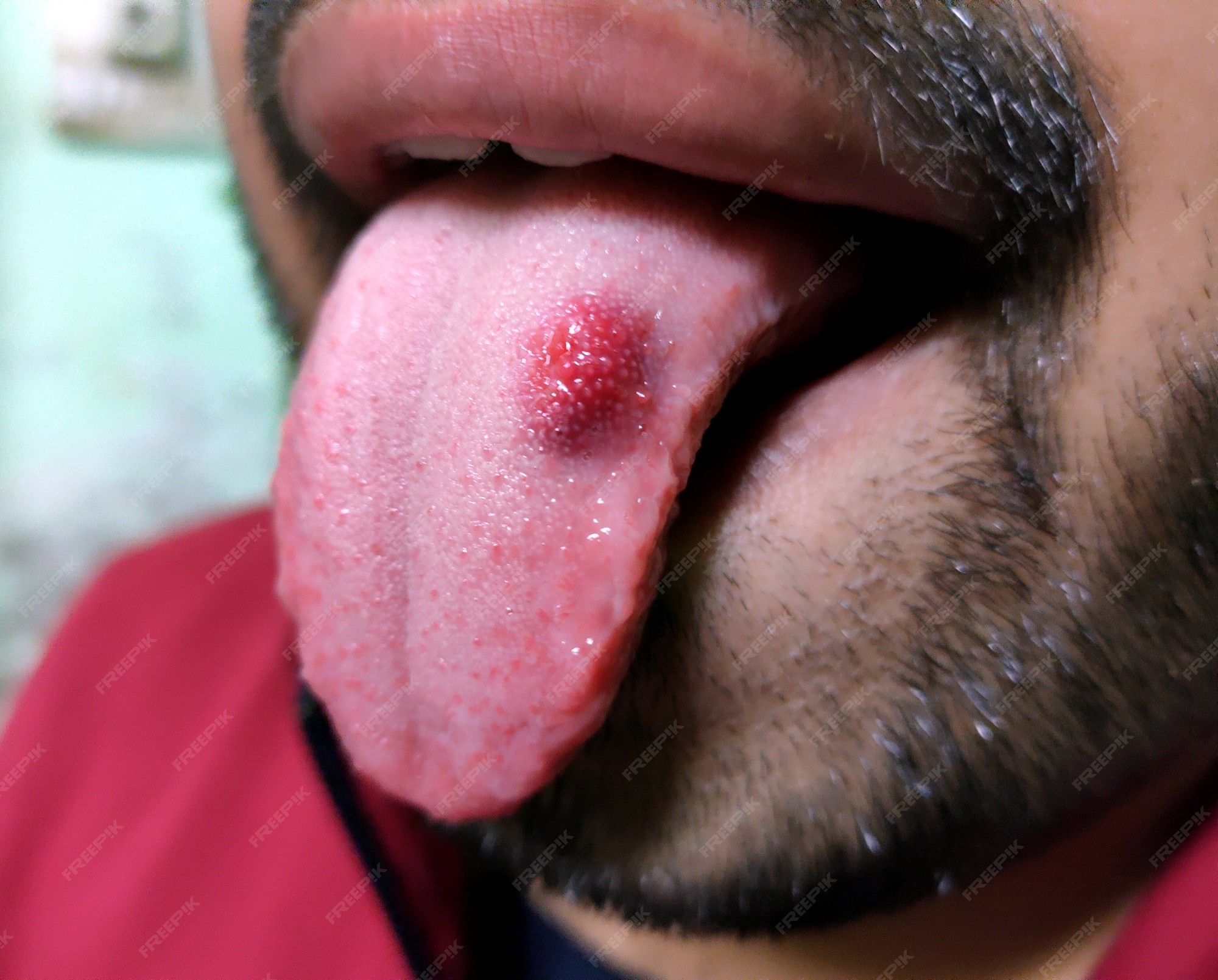 Page 2 | Mouth Ulcer Images - Free Download on Freepik