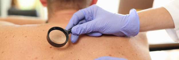 Closeup of doctor with magnifier examining pigmentation on male patient back surgeon looking at