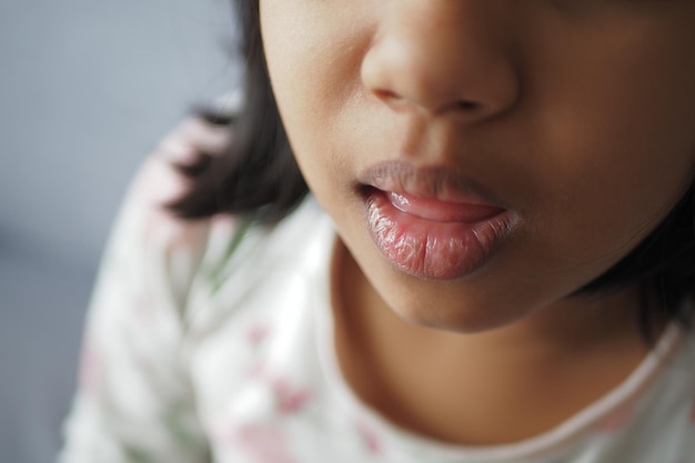 Closeup of dry lip of a baby