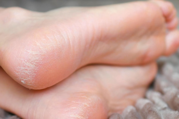 Photo closeup dry skin of heels with cracks on feet