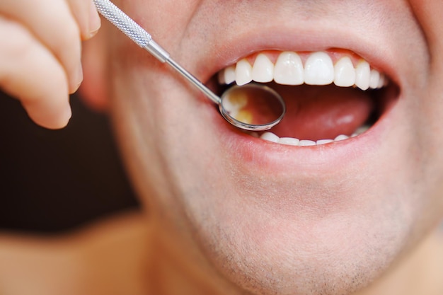 Closeup examination of teeth with veneers with a special dental mirror