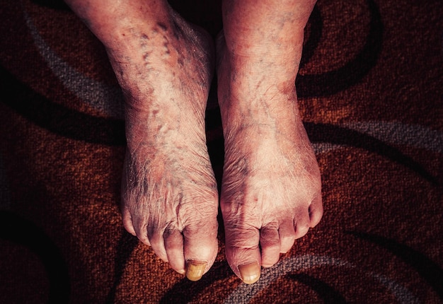 Closeup feet of big old woman's nails