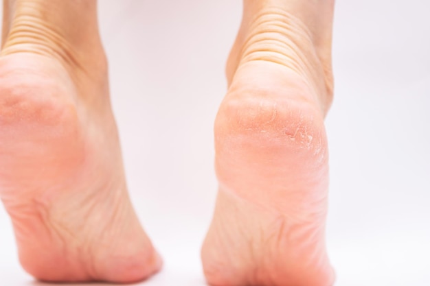 Photo closeup of female feet with cracks and peeling on heels fungal skin infections allergic diseases