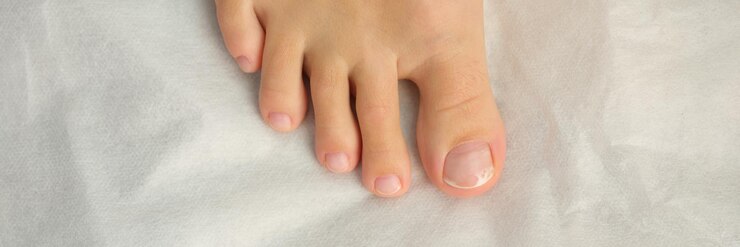 Closeup of female foot with pedicure cosmetic treatment of feet and toenails podology fungus