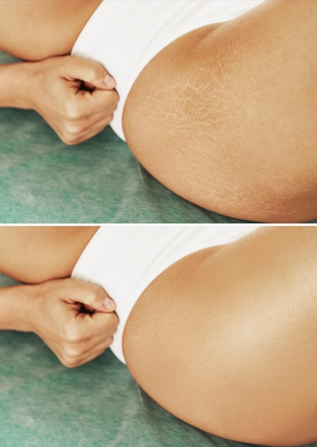 Closeup of female hip with comparison before and after stretch marks treatment