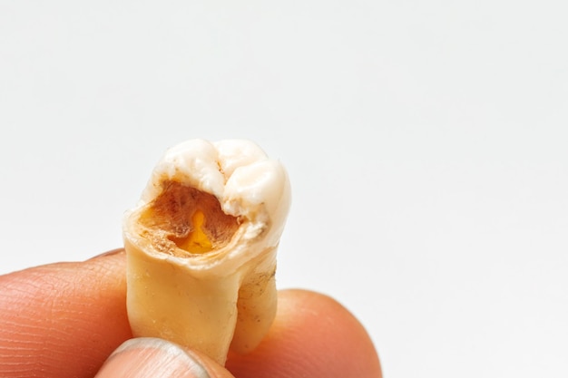 Closeup of fingers holding a tooth chipped by cavities