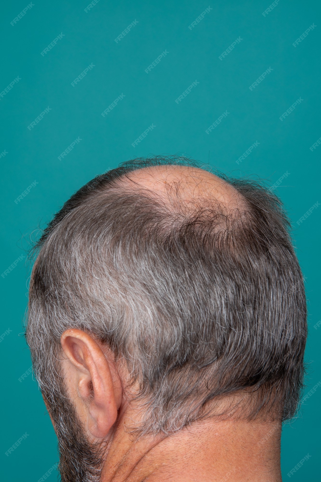 Premium Photo | A closeup of a half-bald male head, hair transplant concept  for hair loss