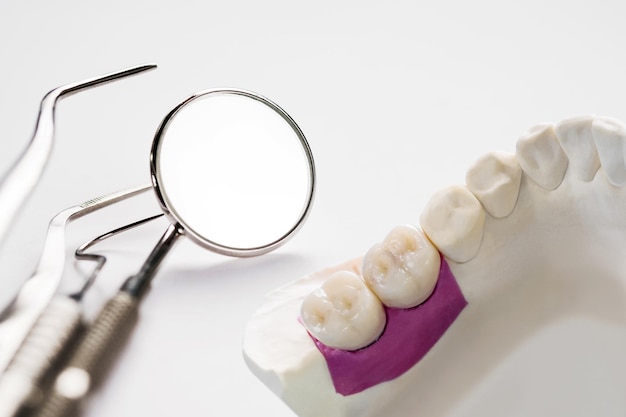 근접 촬영/임플란트 보철 또는 보철/치관 및 브리지 임플란트 치과 장비 및 모델은 복원을 표현합니다.
