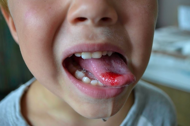 Photo closeup of lips tongue protrusion of blood child39s bitten tongue