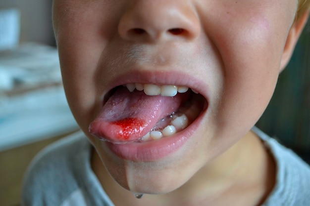 Closeup of lips tongue protrusion of blood Childs bitten tongue