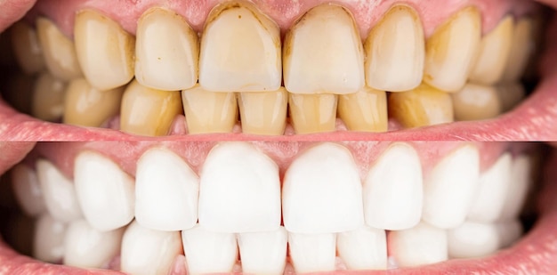 写真 ホワイトニング前後の男性の歯のクローズアップ ホワイトニング前後の男性の歯 オーラルケア歯科口腔病学 歯のホワイトニング手順のクローズアップの前後に笑顔の男