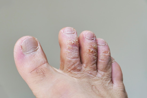 Photo closeup of a man39s toes with fungal disease skin cracking and callus formation on his toes