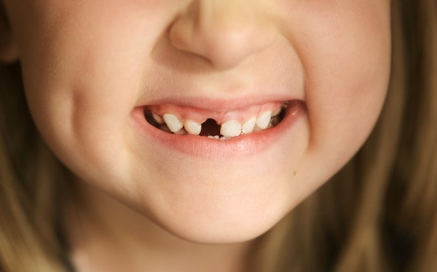 Il bambino con la bocca del primo piano ha perso i denti da latte sostituzione dei denti che cambiano permanentemente sorriso sdentato