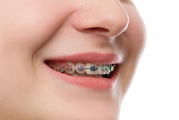 Closeup multicolored Braces on Teeth Beautiful Female Smile portrait with Selfligating Braces Orthodontic Treatment