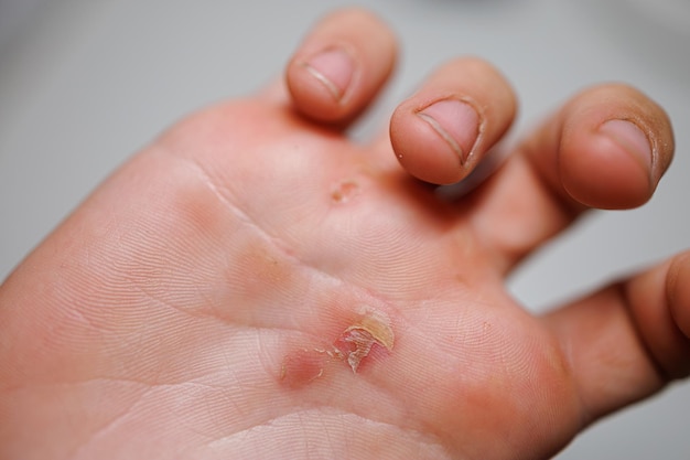 A closeup of the palm of my hand after a hard workoutA lacerated callus on the palm of my hand