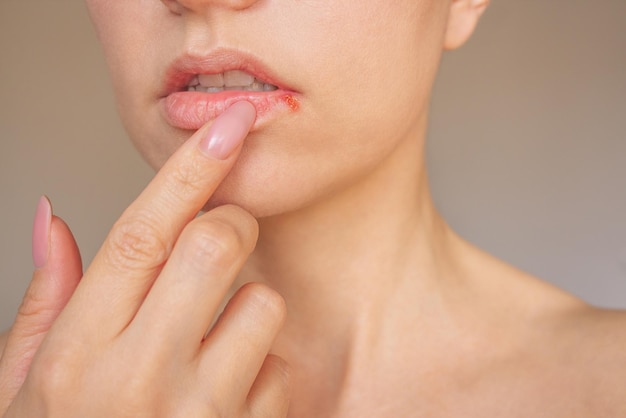 Foto foto da vicino del viso di una giovane donna mostra l'herpes sulle labbra lo stadio di esacerbazione