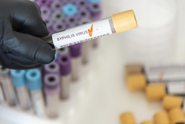 Closeup of positive blood sample from syphilis